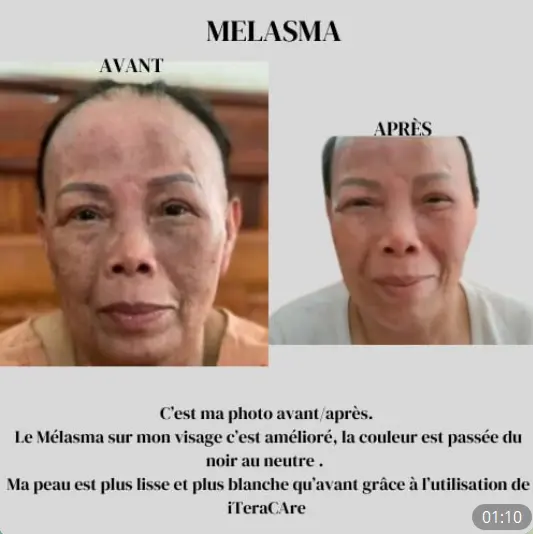 Iteracare témoignage : melasma, amélioration problèmes de peau