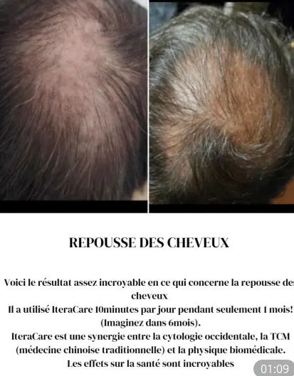 Iteracare témoignage français : cheveux qui repoussent en 1 mois